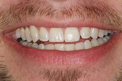 Single tooth Implant crown