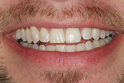 Single tooth Implant crown