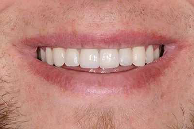 After - 2 upper front teeth crowns and zoom teeth whitening