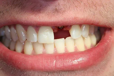 Single tooth implant