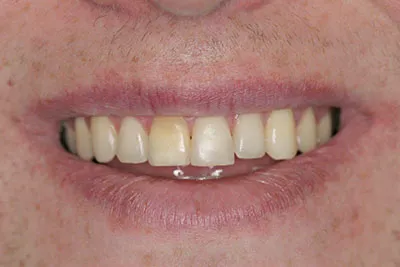 Before dental crowns