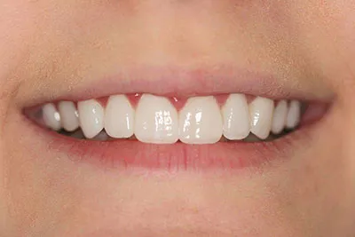 After- gum surgery to change her gum line and 10 porcelain veneers