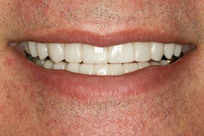 At gum line porcelain veneers on upper and lower 10 teeth