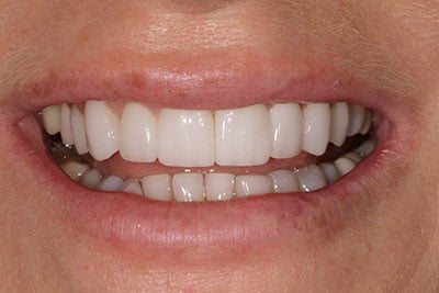 4 upper ceramic crowns, 6 porcelain veneers, reshaped lower teeth and zoom whitening on lower