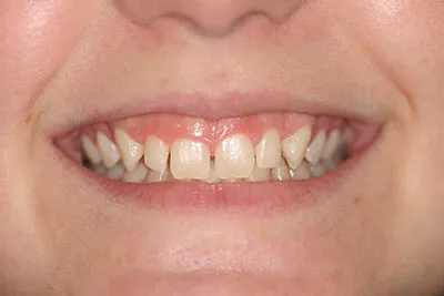 Small teeth, gummy smile and spaces