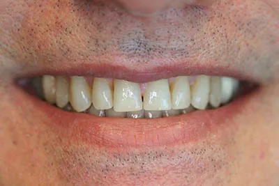 Dark smallish teeth with many spaces between teeth