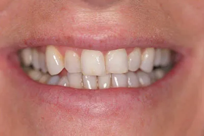 Before- Crowding, dark and worn teeth