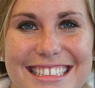 Before dental bonding 
