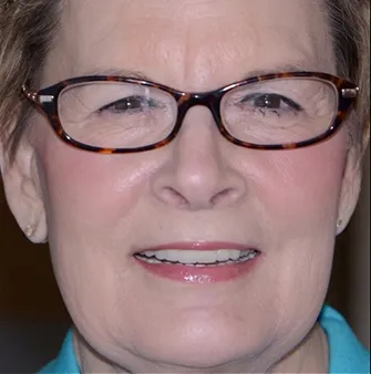 Full Mouth Reconstruction After