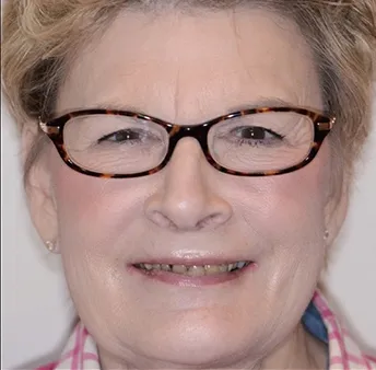 Full Mouth Reconstruction Before