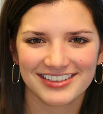 after dental implants