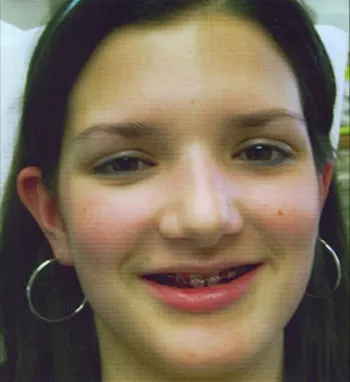 before dental implants