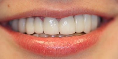 after dental implants