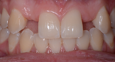before dental implants