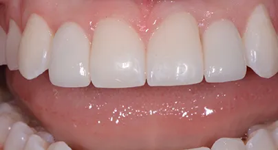 after dental implants