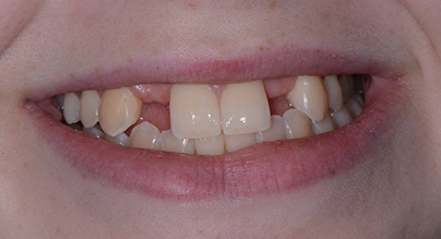 before dental implants