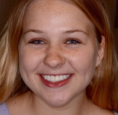 after dental implants