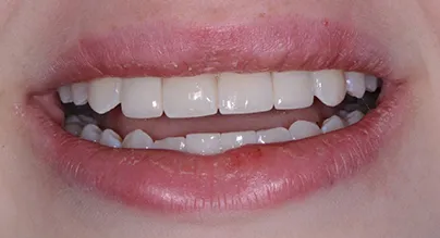 after dental implants