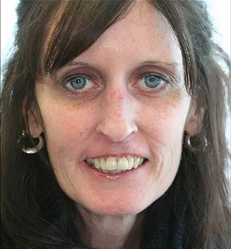 before dental implants