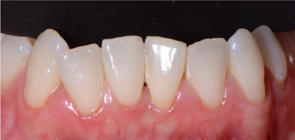 Cosmetic reshaping of Teeth Before