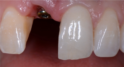 Single tooth Implant crown