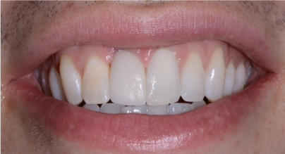 screw retained implant crown