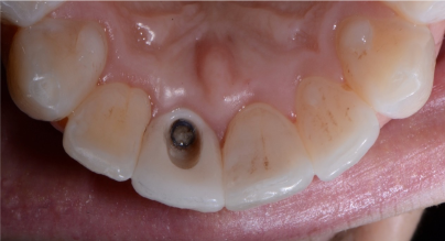 screw retained implant crown