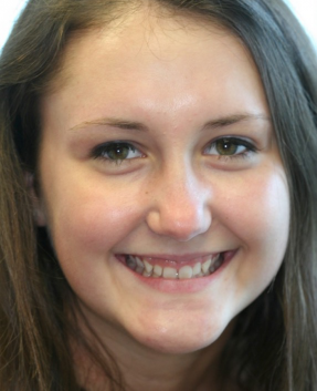 Gummy Smile correction before