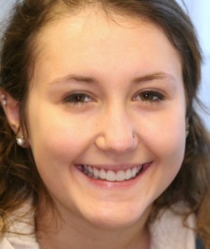 Gummy Smile correction after