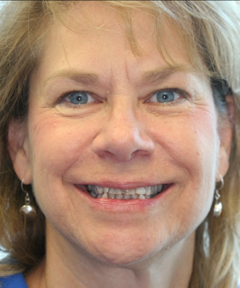 Before dental crown