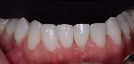 cosmetic reshaping of teeth After