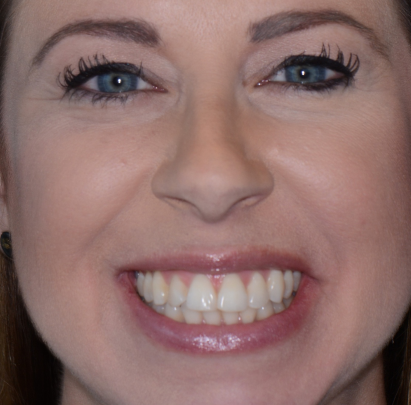 before dental crown