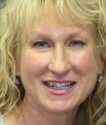 before dental crown