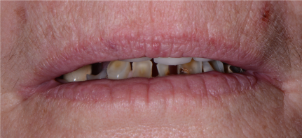 dentures1 before