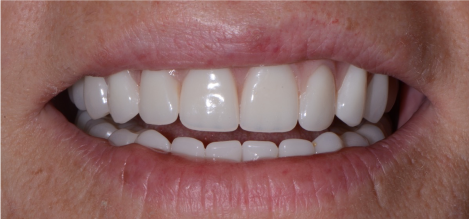 Dentures1 after
