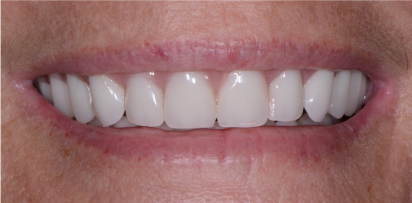 full mouth reconstruction 3 after