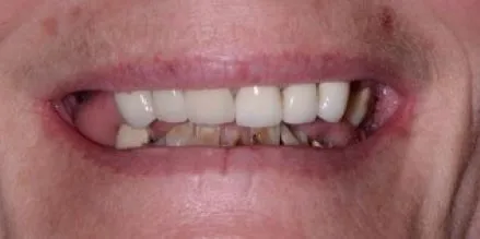Before & after photo of a patient after full mouth reconstruction