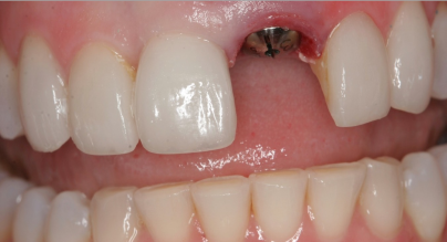 single tooth implant 1