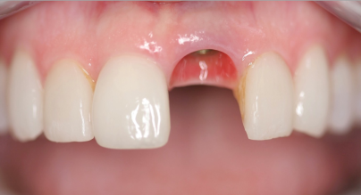 single tooth implant 2