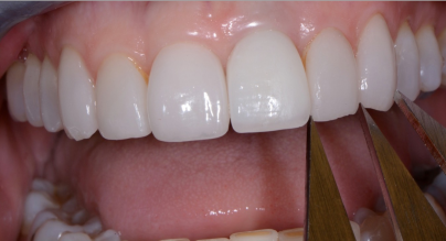 single tooth implant 3