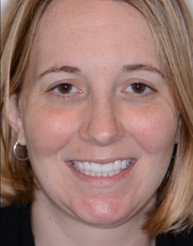 veneers 2 after photo
