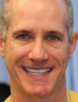 After Photo - Dental Veneers