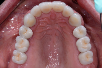 After Photo - Dental Veneers