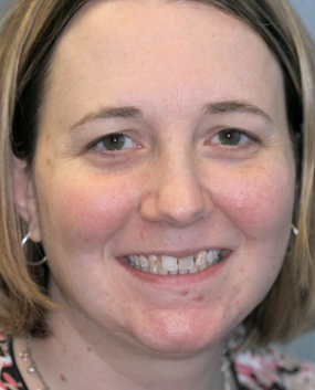 veneers before