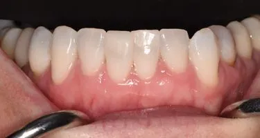 After Dental Bonding and Eshetic Contouring