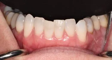 Before Dental Bonding and Eshetic Contouring