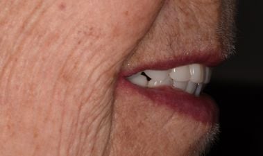 Image of teeth After dentures