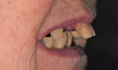 Image of teeth before dentures