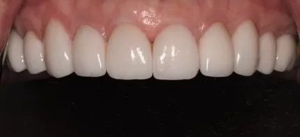 Image of teeth after veneers