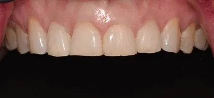 Image of teeth before veneers